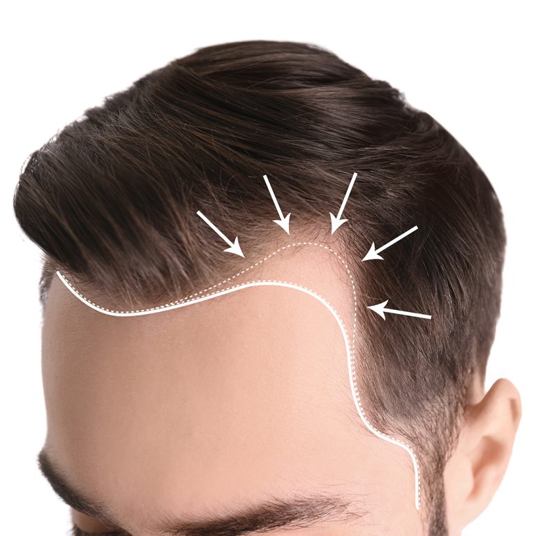 Young man with hair loss problem on white background, closeup